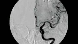 BRAIN ANEURYSM  ANEURISMA CEREBRAL 2 [upl. by Nnorahs]