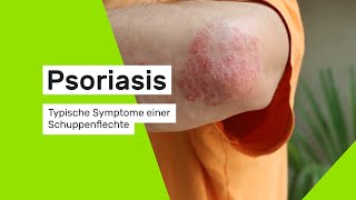 Schuppenflechte Typische Symptome einer Psoriasis [upl. by Hoashis691]