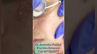 Freckle Removal in Gurgaon For an appointmentCall on 8875865077 or visitwwwdranweshapoddarcom [upl. by Gilda]