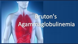 Brutons agammaglobulinemia [upl. by Akerue152]