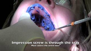 Dental Implant  Impression and Insertion of crown [upl. by Nahsar765]