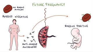 Understanding Rhesus Status and AntiD in Pregnancy [upl. by Eanore]