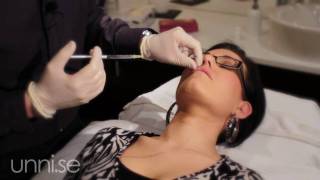 Botox amp Restylane  Behandlingar Biverkningar Läppar Botox amp Restylane [upl. by Burnight]