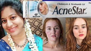 Acne Star Gel amp Acne Star soap Review in telugu HOW TO GET RID OF ACNE FAST [upl. by Ellerred]