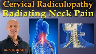 Cervical Radiculopathy Radiating Neck Pain  Dr Mandell Live Stream [upl. by Bakemeier]