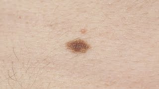 Melanoma symptoms How to spot signs and when to see a doctor [upl. by Natsyrk]