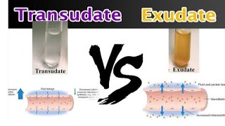 Transudate and Exudate pathology transudate Vs ExudateEasy to understand pathology [upl. by Ayila1]