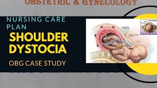 case study on shoulder dystociaIntranatal care plan obg obstructedLabor care plan [upl. by Robenia]