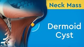 Neck Mass Dermoid Cyst [upl. by Sean]