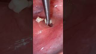 The Most Disgusting Tonsil Stones EVER [upl. by Hserus926]