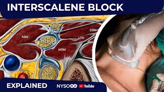 USGuided Interscalene Brachial Plexus Block  Regional anesthesia Crash course with Dr Hadzic [upl. by Flem778]