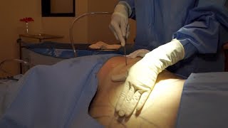 SmartLipo vs Liposuction [upl. by Nathan375]