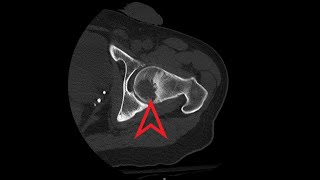 Hip CT Lytic Lesions from Multiple Myeloma [upl. by Yreved]