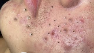 Big Cystic Acne Blackheads Extraction Blackheads amp Milia Whiteheads Removal Pimple Popping  5361 [upl. by Eizus98]