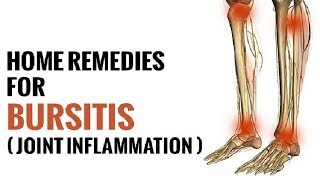 5 Remedies For Bursitis  How to Treat Bursitis  By Top 5 [upl. by Annaiv]