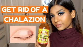 HOW TO GET RID OF A CHALAZION FAST AT HOME [upl. by Notanhoj190]