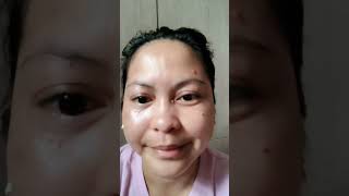 KASOY OIL MOLE REMOVAL  effective nga ba [upl. by Huckaby]