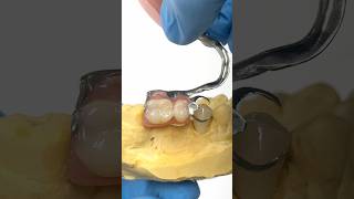 Adding a Crown for a Metal Clasped Partial lsk121shorts dentistry teeth [upl. by Ecnarwal]