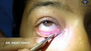 Lacrimal Syringing Technique and Interpretation [upl. by Ahsats]