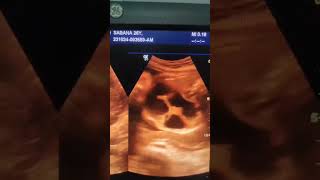 Fetal bowel dilatation Ultrasound shorts video shorts [upl. by Nich769]