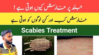 Scabies Treatment in Urdu Hindi  Kharish Ka ilaj  Skin Allergy  Itching  Kharish kyu hoti hai [upl. by Michal]