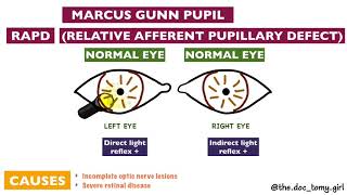 Abnormal Pupillary Reflexes  Ophthalmology [upl. by Loy188]