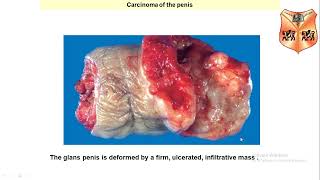 Male Genital System Pathology Penile and Testicular Areas [upl. by Mccandless]