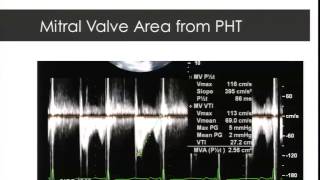 Dr Bruce Cartwright Intraoperative Echocardiographic Assessment During Mitral Valve Repair [upl. by Scurlock744]