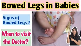 Bowed legs in babies in hindi  Bowed legs के लिए कब डॉक्टर को दिखाएं [upl. by Otnas]