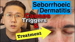 Seborrhoeic Dermatitis  Causes Triggers amp Treatment Options [upl. by Debbi]