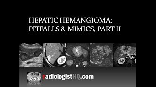 Hepatic Hemangioma Pitfalls amp Mimics Part II [upl. by Aihtniroc963]