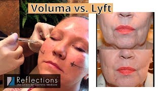 Voluma vs Restylane Lyft Filler Options Compared for Cheeks Chin Nose Temples amp More [upl. by Lindsey830]