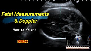 Fetal measurements and Doppler  How to do it [upl. by Cerell]