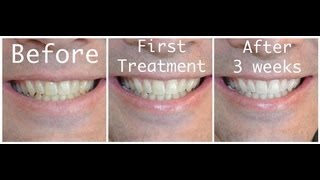 Howto Whiten your teeth with Hydrogen Peroxide [upl. by Anilegna]