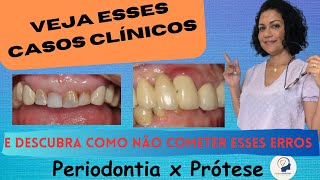 RELAÇÃO PERIODONTIA PRÓTESE [upl. by Nitin363]