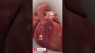 Animation of balloon angioplasty with stent procedure [upl. by Lleihsad244]