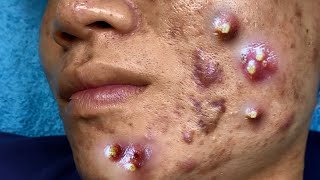 Big Cystic Acne Blackheads Extraction Blackheads amp Milia Whiteheads Removal Pimple Popping 095 [upl. by Eedyah]