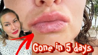 Angular Cheilitis gone in 5 daysLip eczemacracked lips red corners mouth SHOCKING FAST RESULTS [upl. by Lian]