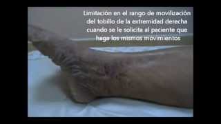 Insuficiencia Venosa Mixta mixed venous insufficiency [upl. by Duaner]