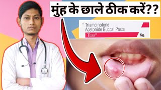 Triamcinolone oromucosal paste bp 01 ww  मुंह के छाले ठीक करें  Oraways paste in hindi [upl. by Aniarrol]