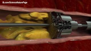 Stent Angioplasty Procedure [upl. by Ginni]