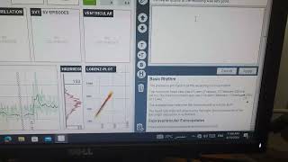 Applied Holter Study analysis 2 [upl. by Ogren]