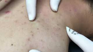 New Blackheads amp Cystic Removal For Boy 2024 Acne Perennial On Back [upl. by Eyot]