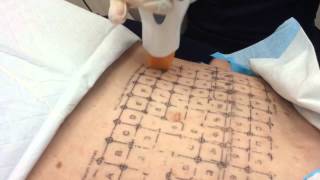 Thermage Treatment of the Abdomen  Dr Michael Kaminer [upl. by Acsirp]