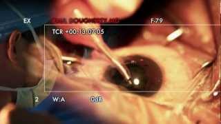 Learning how to perform Cataract Surgery [upl. by Malony]