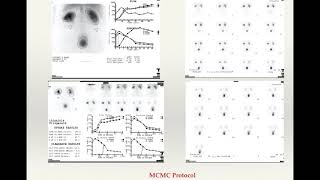 Renal Scintigraphy [upl. by Aric603]