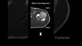 MRI arthrogram – shoulder Quiz 22 radiologychannel007 [upl. by Snah760]