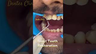 Fixing Chipped Front Teeth in Minutes dentist [upl. by Mcginnis498]