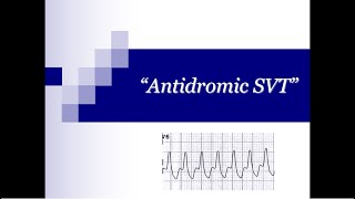 ECG Tip 21 What about quotAntidromicquot SVT [upl. by Orag]