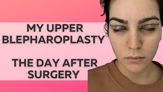 UPPER BLEPHAROPLASTY  PART 1 VLOG WHAT HAPPENED DURING SURGERY [upl. by Troth]